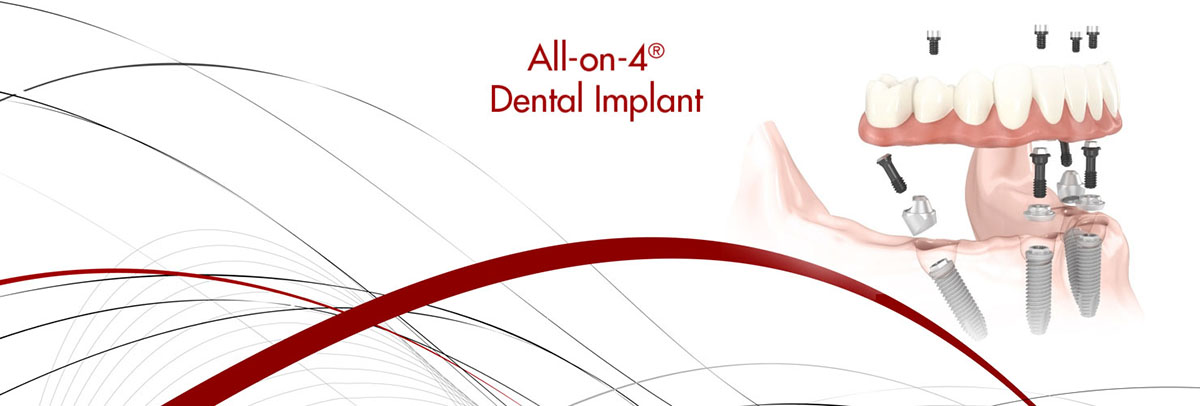 Chicago All-on-4 Dental Implants