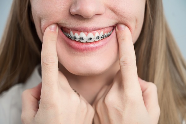 Traditional Braces: A Time Tested Method For Achieving A Perfect Smile