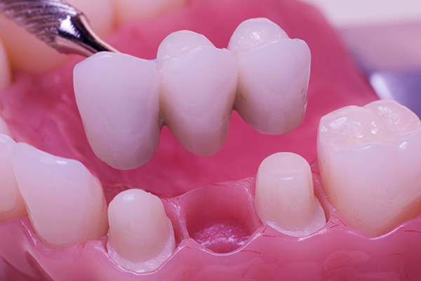 Is A Dental Bridge Or A Dental Implant Best For Missing Teeth?