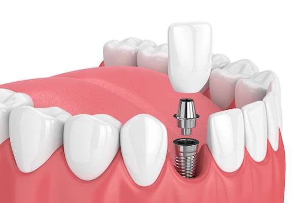 How Painful is Dental Implant Surgery from Total Care Dental in Chicago, IL