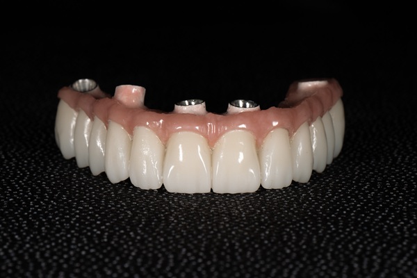 Benefits Of Implant Supported Dentures