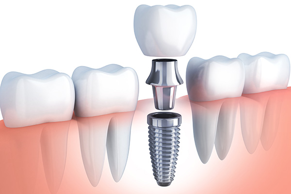Questions to Ask Your Implant Dentist from Total Care Dental in Chicago, IL